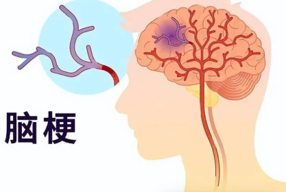 脑梗发生前1周，身体就反复提醒你了！可惜太多人当成“累了”